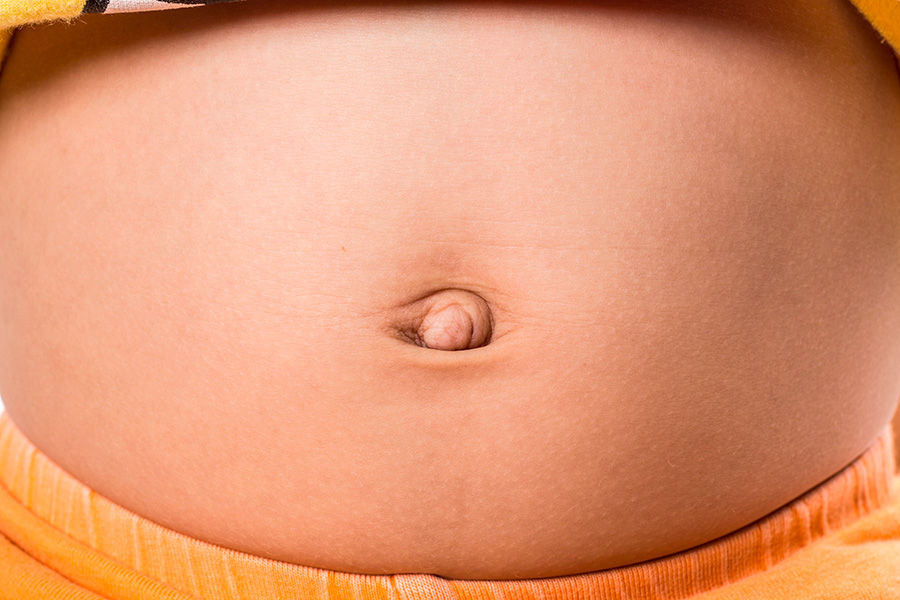 Hernias abdominales durante el embarazo