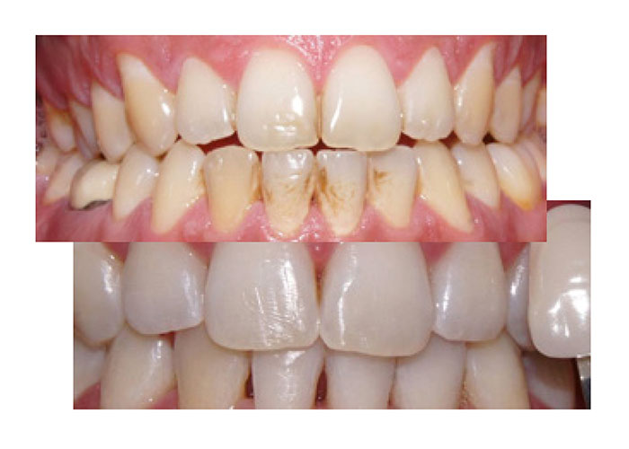 Limpieza dental vs blanqueamiento