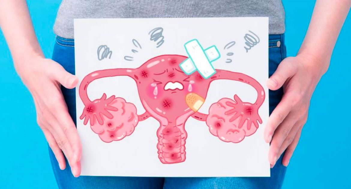 ¿qué Es El Síndrome De Ovario Poliquístico Relevancia Médicaemk 4086