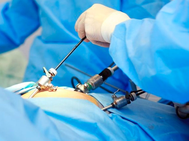 Beneficios y detalles de la cirugía mini laparoscópica