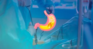 Cirugía de Nissen y el reflujo gastro esofágico