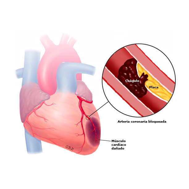 Relevancia de la Falla Cardiaca en la actualidad